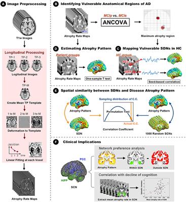 Posterior Cingulate Cortex Network Predicts Alzheimer's Disease Progression